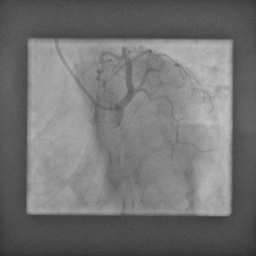 Coronary Angiogram