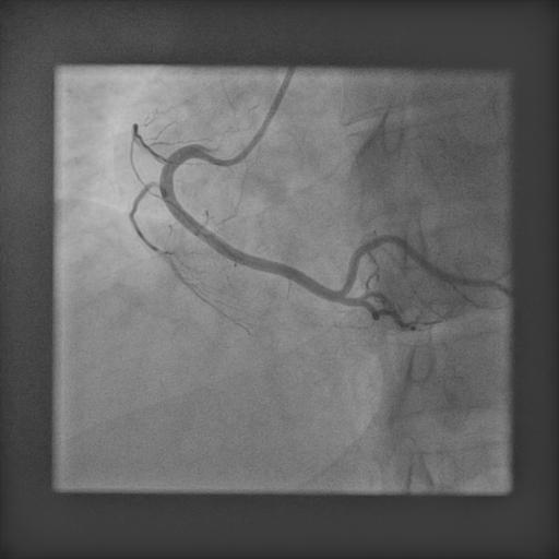 Coronary Angiogram
