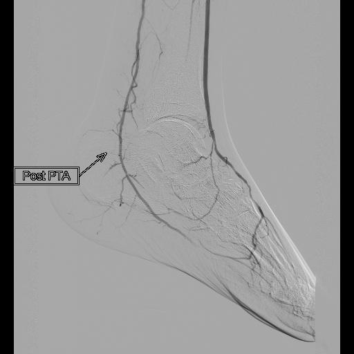 Peripheral plasty 1 post 1