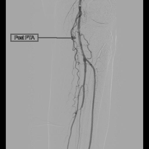 Peripheral plasty 1 post