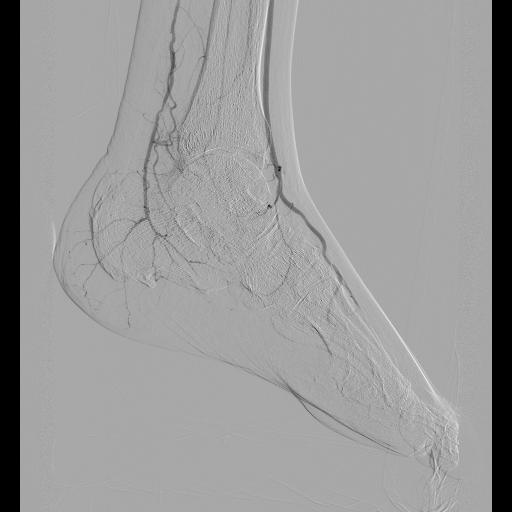 Peripheral plasty 1 pre 1