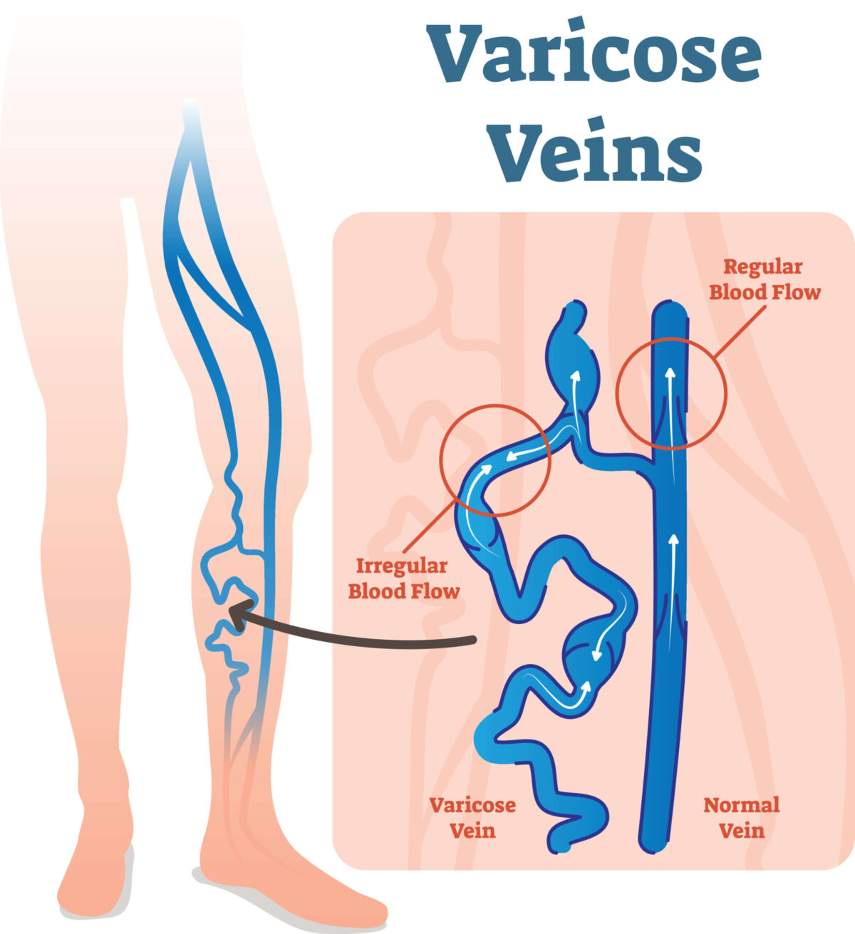 VERICOSIS-2-scaled