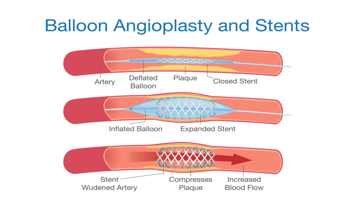 Balloon Angioplasty and Stents