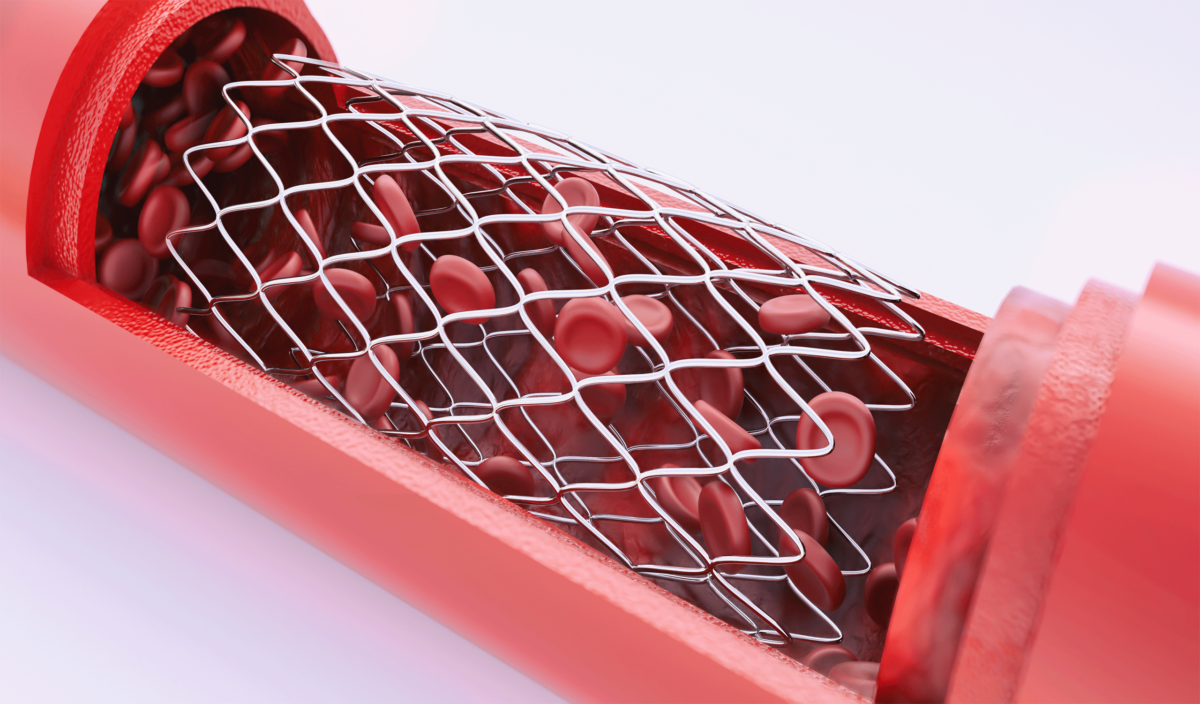 Angioplasty
