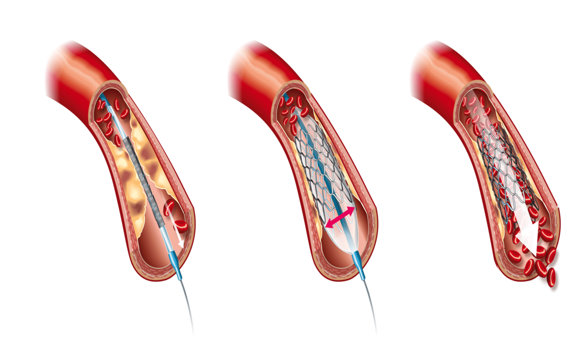 Angioplasty Stent