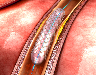 cci-coronary_angioplasty.jpg