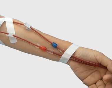 cci-dialysis_fistuloplasty.jpg