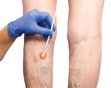 cci-radiofrequency_ablation.jpg