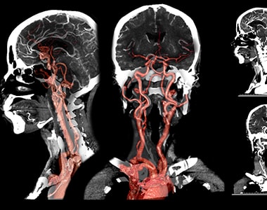 diagnosis-procedure-carotid_and_cerebral.jpg