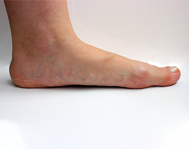 disease-condtions-critical_limb_ischemia.png