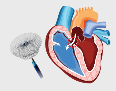 disease-condtions-device_closure_for_asd.jpg