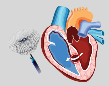 disease-condtions-device_closure_for_vsd.jpg