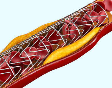 disease-condtions-percutaneous_coronary_intervention.jpg