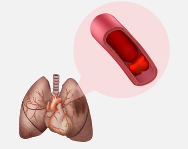 disease-condtions-pulmonary_embolism.jpg