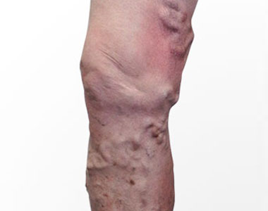disease-condtions-varicose_veins.jpg