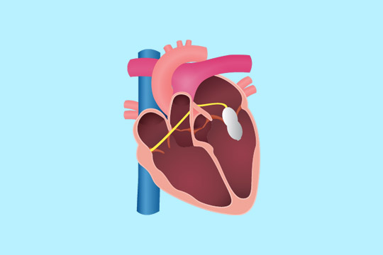 mitral-balloon.jpg
