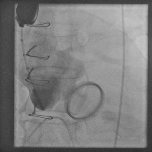 tavr 1