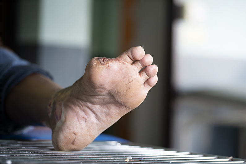 CRITICAL LIMB ISCHEMIA
