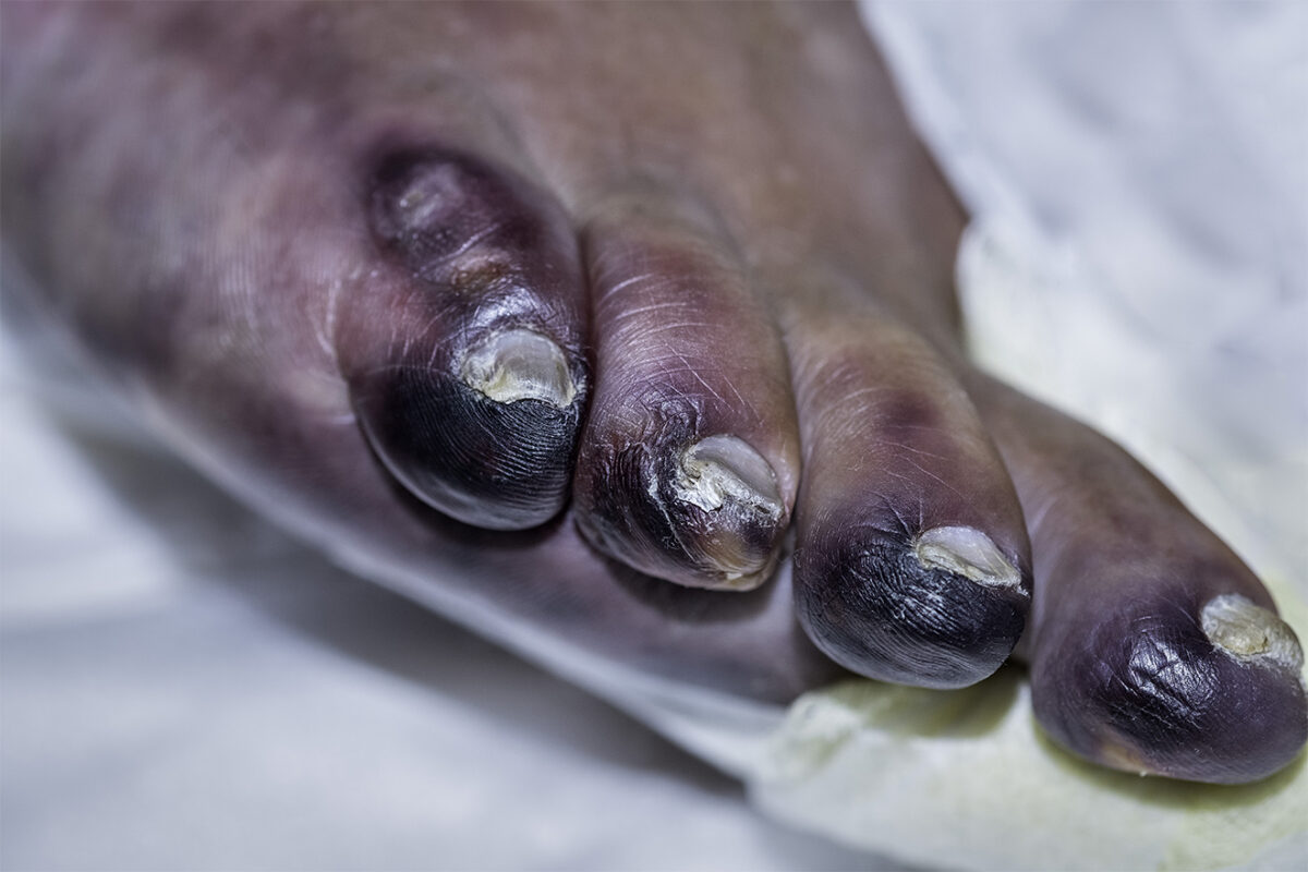 Chronic Limb Ischemia