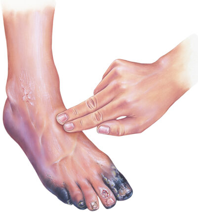 Chronic Limb Ischemia