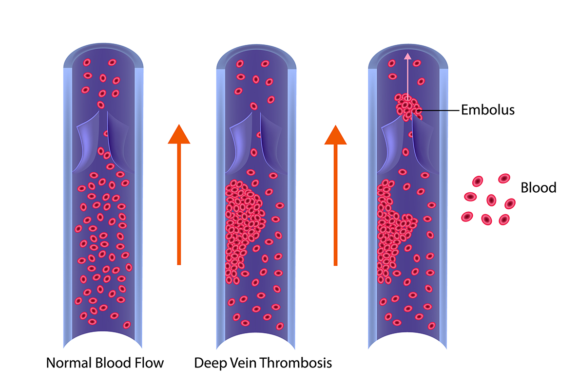 Deep Vein Thrombosis vs normal