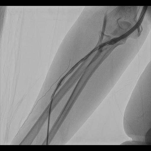 Fistuloplasty