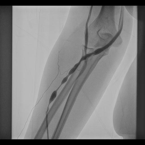 FISTULO PLASTY PRE