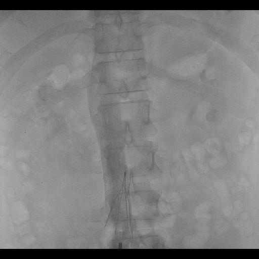 Inferior Vena Cava