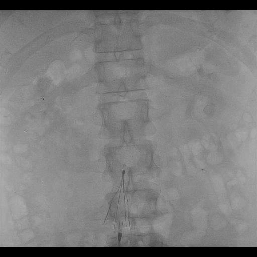 IVC FILTER 2