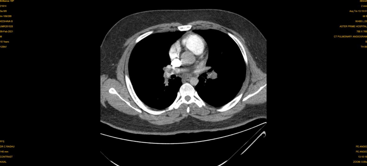 Pulmonary Embolism CT 1