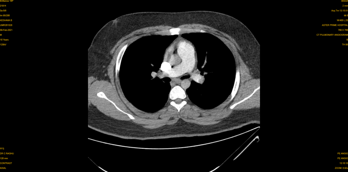 Pulmonary Embolism CT 4