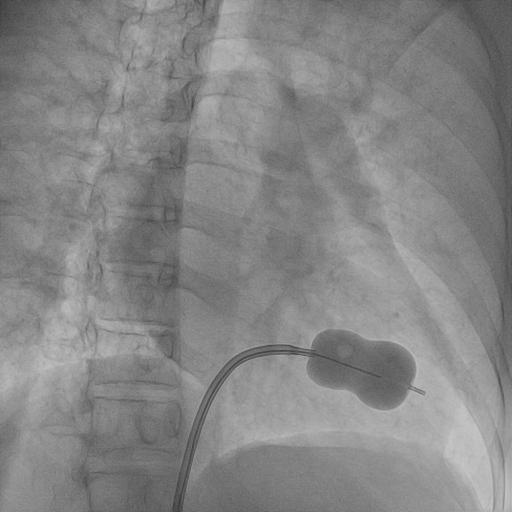Balloon Mitral Valvotomy