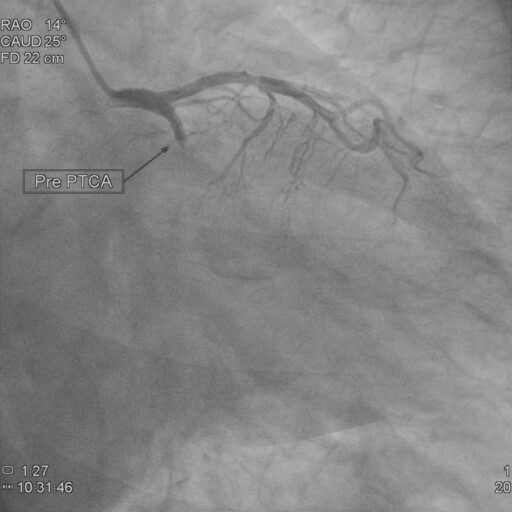 primary angioplasty