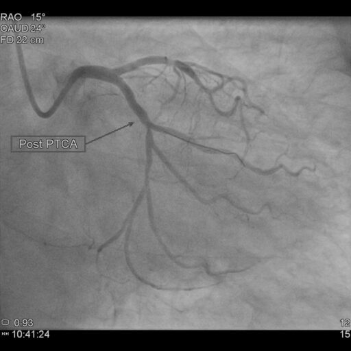 PRIMARY PCI 2