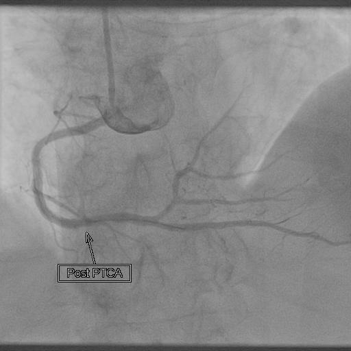 PRIMARY PCI POST