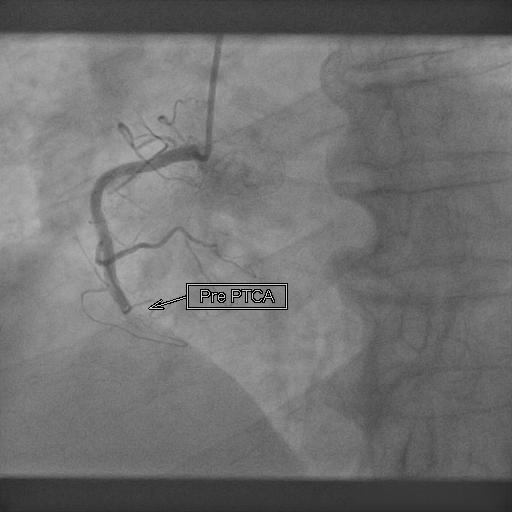 PRIMARY PCI PRE