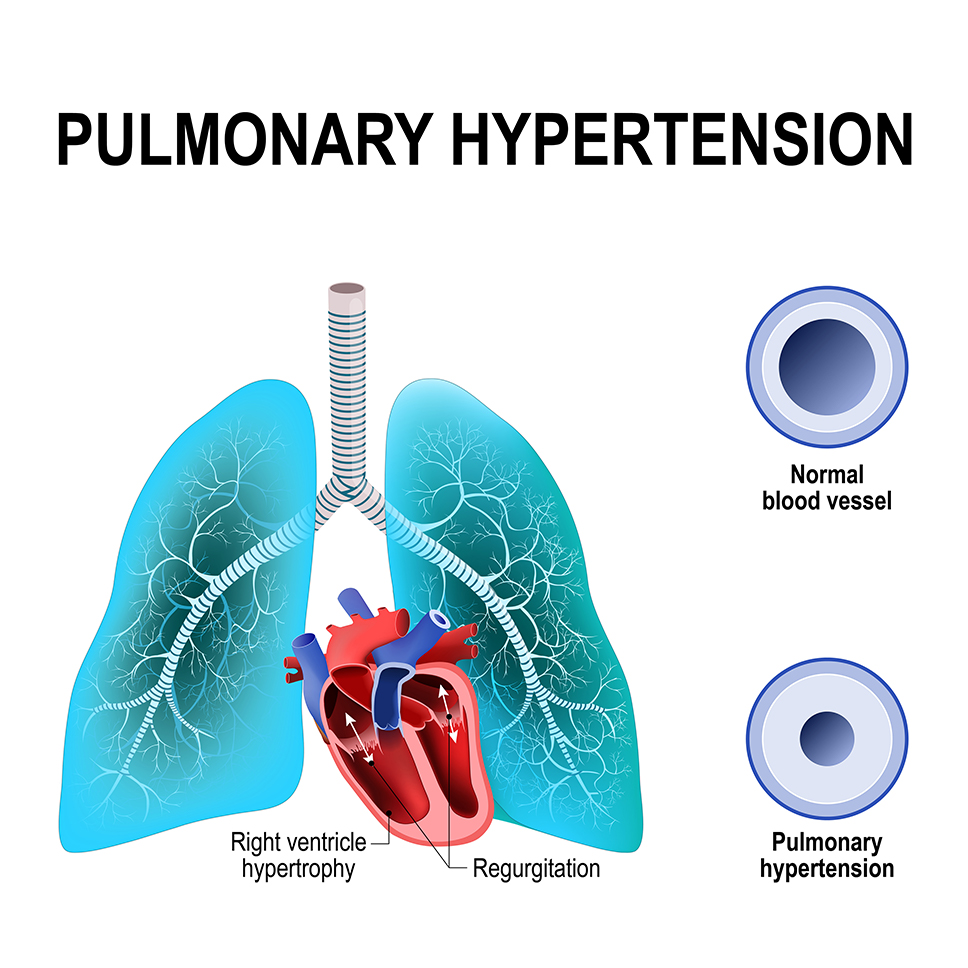 Pulmonary-Hypertension.jpg