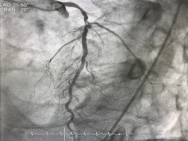 Coronary-Bifurcation-Lesions.jpg