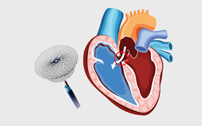 atrial-septal-defects