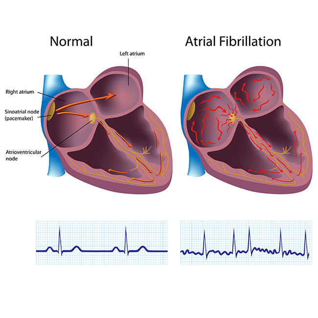 AFIb.jpg