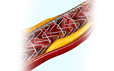 Coronary-Bifurcation.jpg