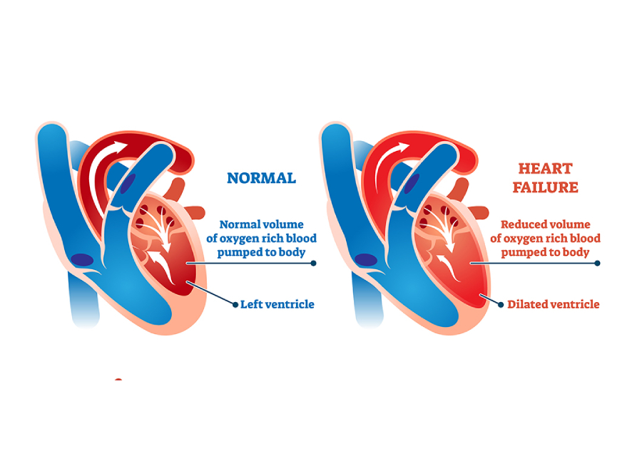 Left-heart-failiure.jpg