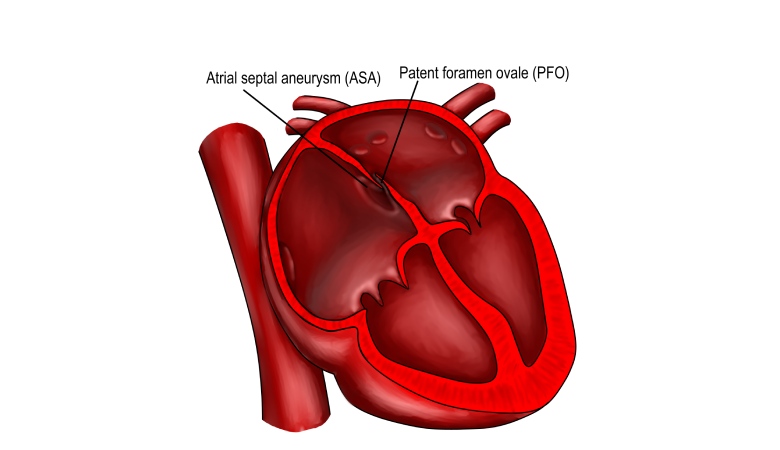 patent-foramen.jpg