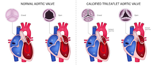 Aotic-Valve.jpg