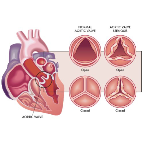 aortic-stenosis-1.jpg