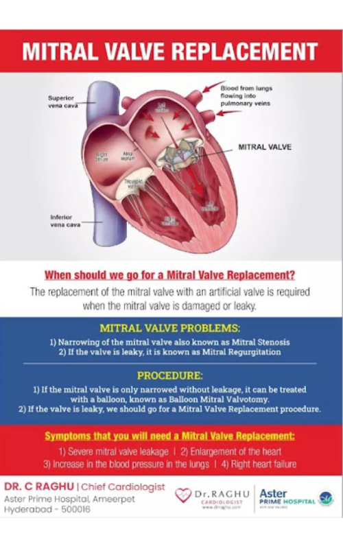 mitral-vale-replacement