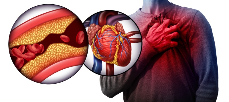 myocardial-infarction.jpg