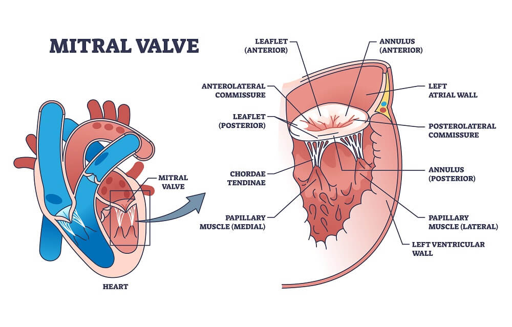 Transcatheter-Edge-to-Edge-Repair-Mitral-Valve-Regurgitation.jpeg